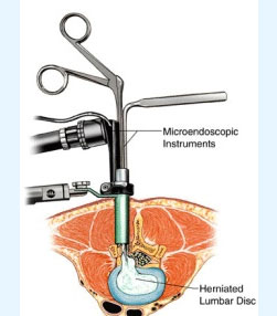 MES (Micro Endoscopic Surgery) For Spine