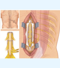Spinal Cord Surgery